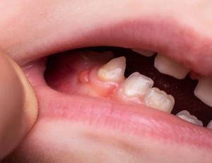 Fístulas dentales