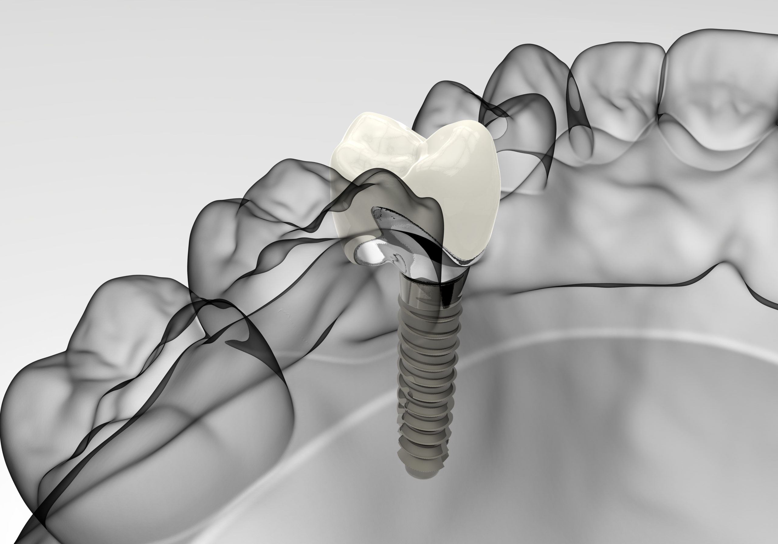 Implantología Madox Dental